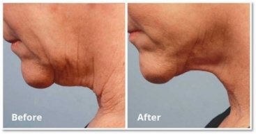 RF Skin Tightening Manhattan | Forma &amp; Forma Plus NYC